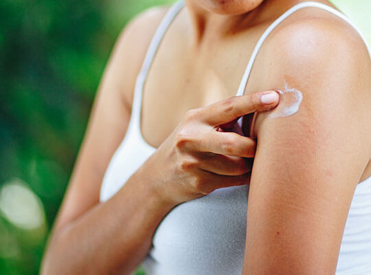 A young woman applying an anti-itch lotion to a mosquito bite on her arm.